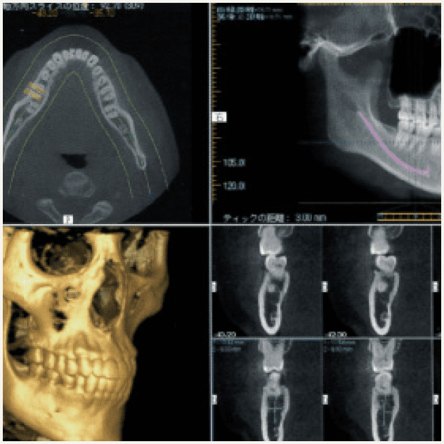 歯科用CT