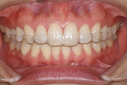 歯ぎしり治療イメージ03