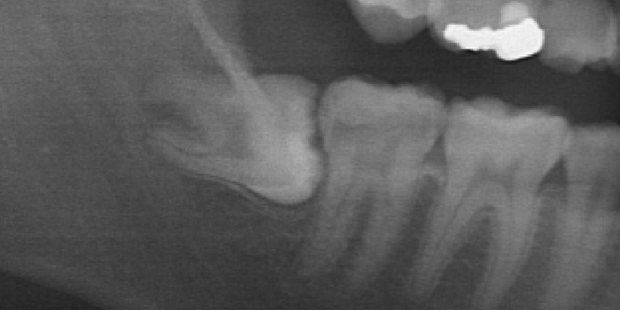 親知らずの抜歯･歯の移植イメージ01