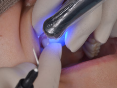 むし歯･歯周病治療