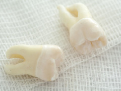 親知らずの抜歯･歯の移植