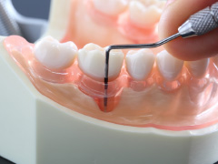 歯周治療･歯肉移植