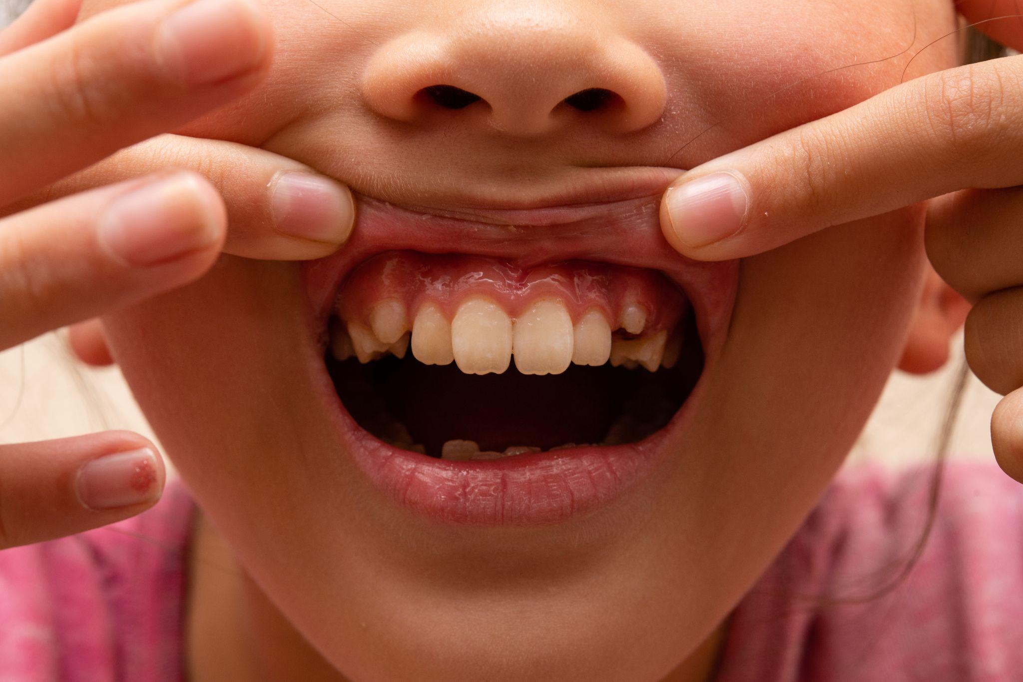 矯正治療を検討した方がいい子供の歯並び