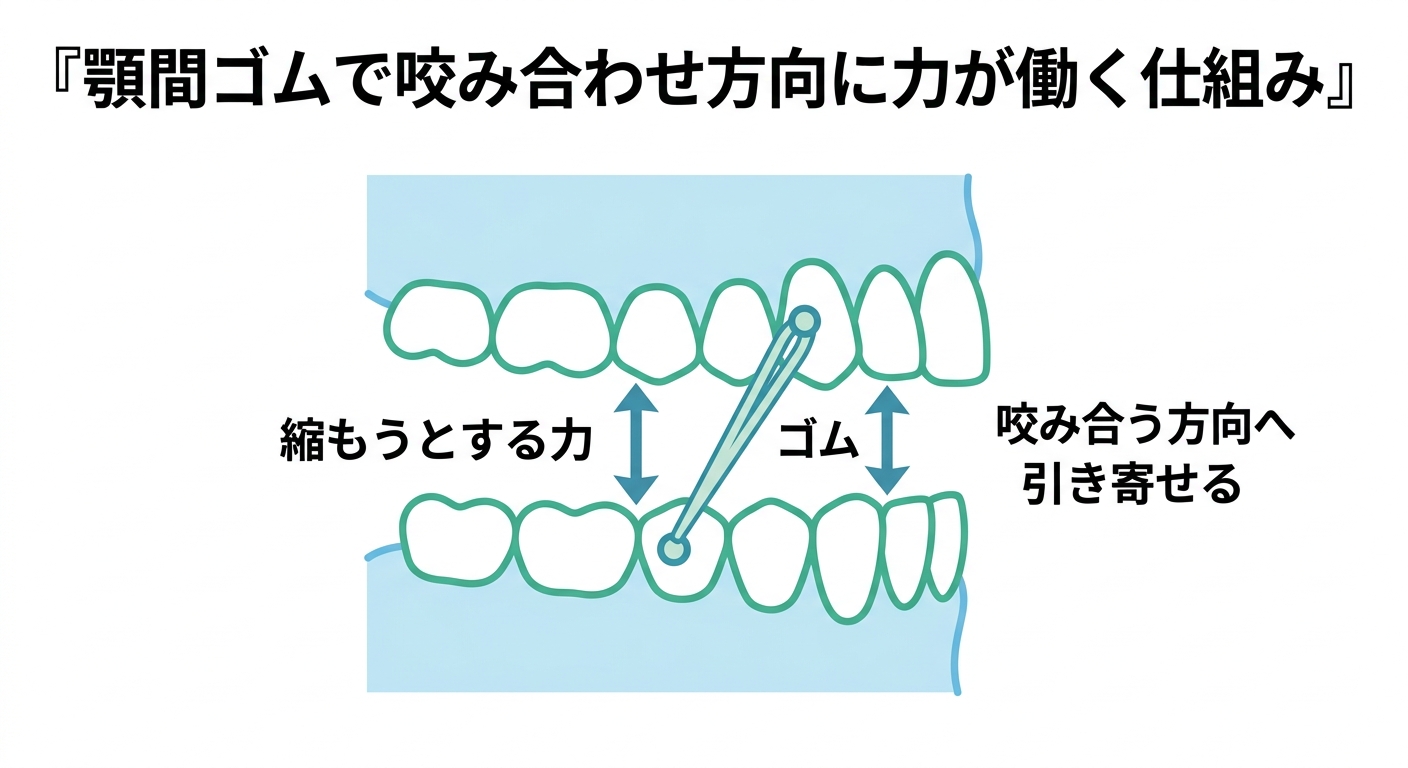 ゴムかけの役割｜なぜ咬み合わせの仕上がりに重要なのか