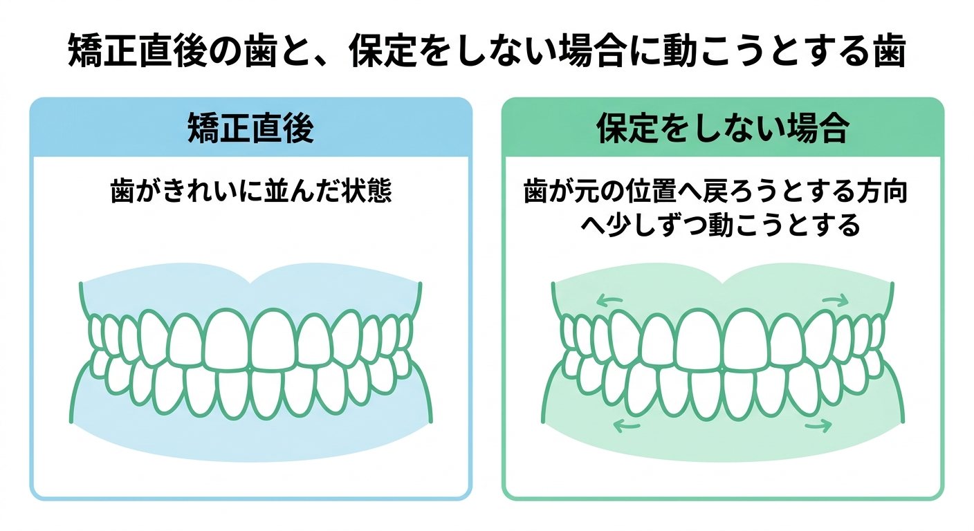 そもそも「後戻り」とは？インビザラインでも起こるのか